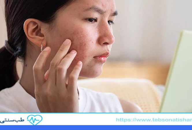 رفع لک صورت با طب سنتی
