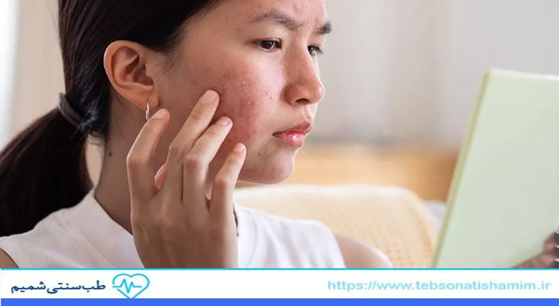 رفع لک صورت با طب سنتی