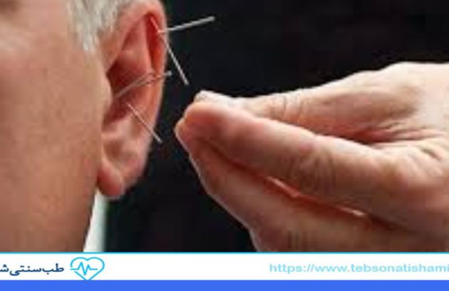 درمان مشکلات شنوایی با طب سوزنی
