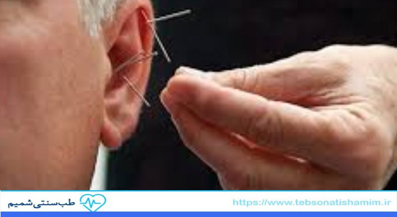 درمان مشکلات شنوایی با طب سوزنی