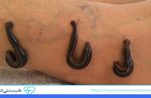 زالو درمانی برای واریس پا