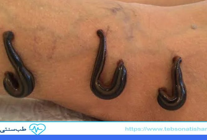 زالو درمانی برای واریس پا