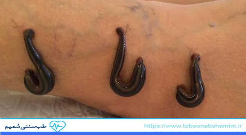 زالو درمانی برای واریس پا