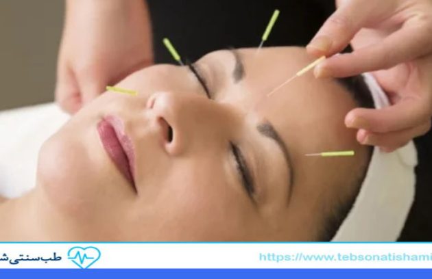 لیفت صورت با طب سوزنی