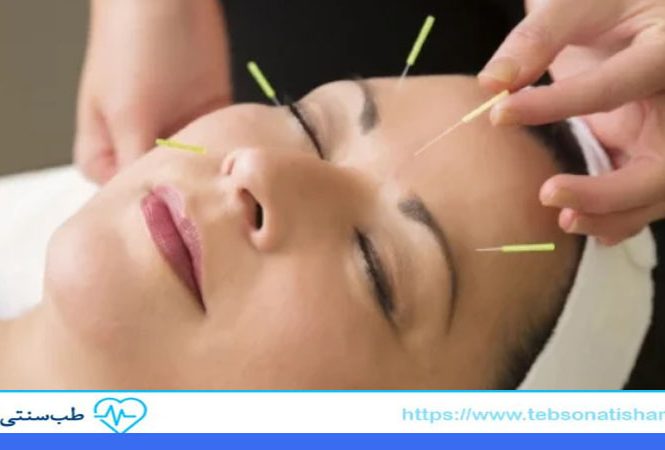لیفت صورت با طب سوزنی